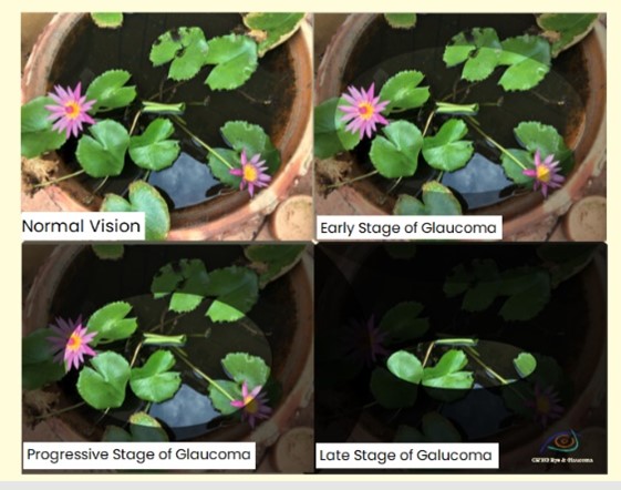 青光眼是视力的小偷