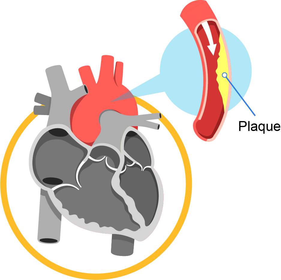 Coronary Artery Disease (CAD) | Pantai Hospital