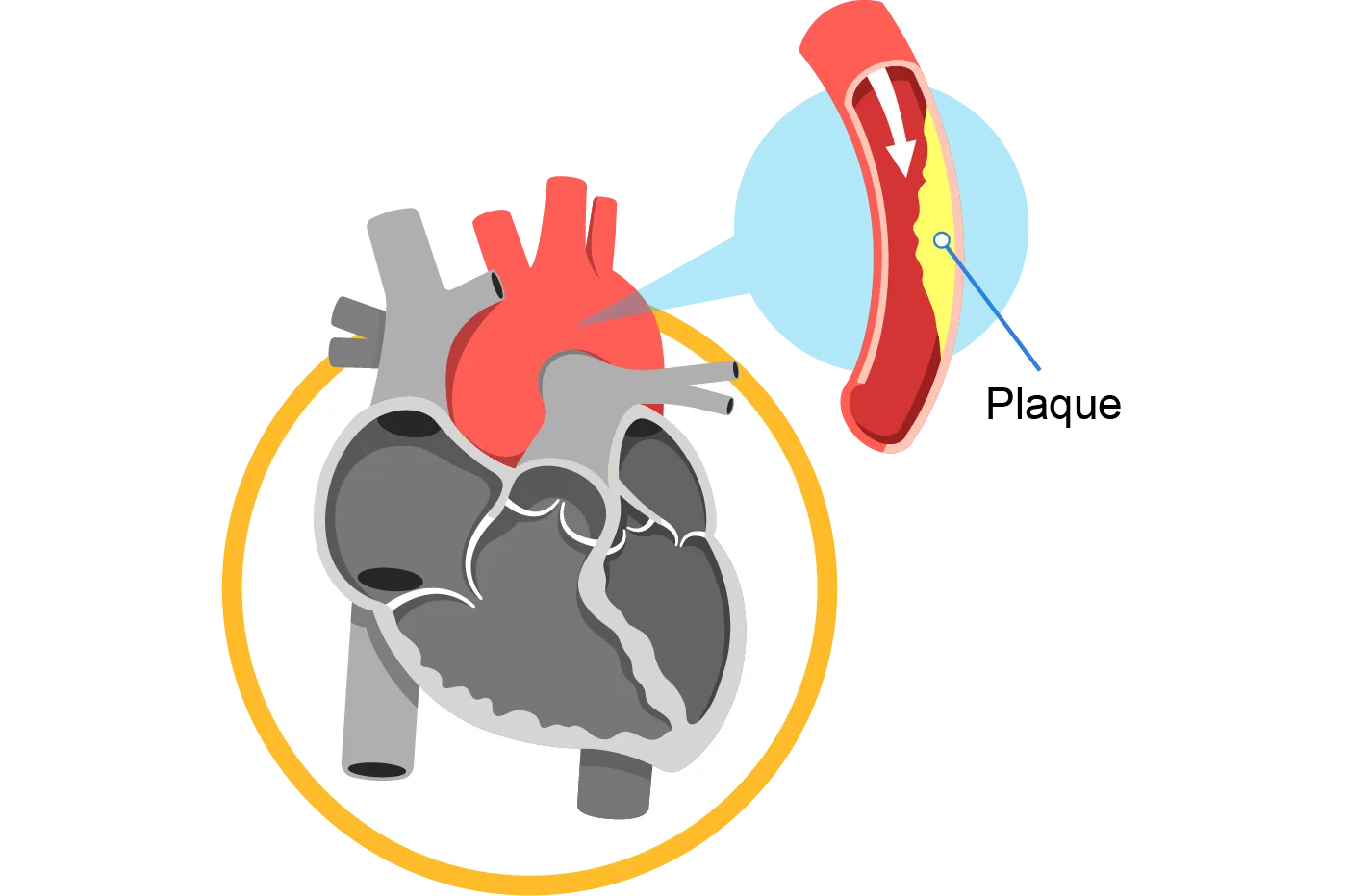 plaque build-up in coronary arteries