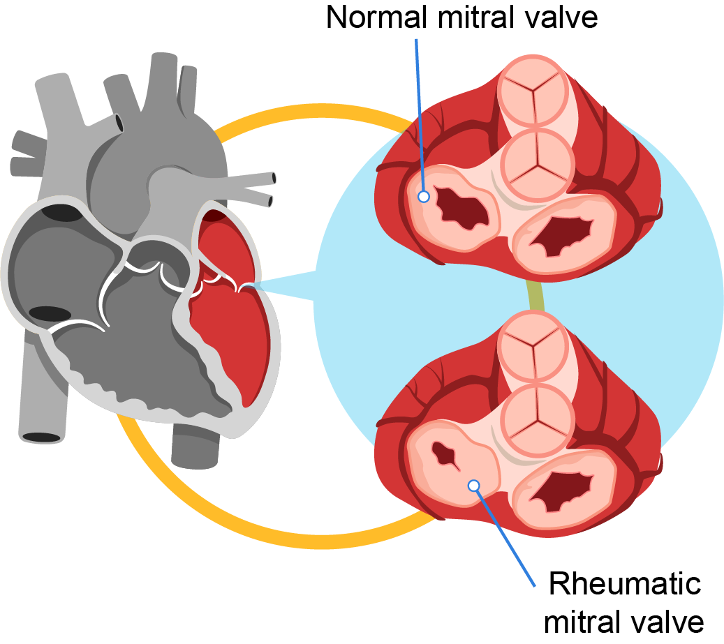 Rheumatic Heart Disease: Symptoms & Causes | Pantai Hospital