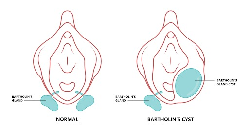 Learn about Bartholin's gland cyst removal technique