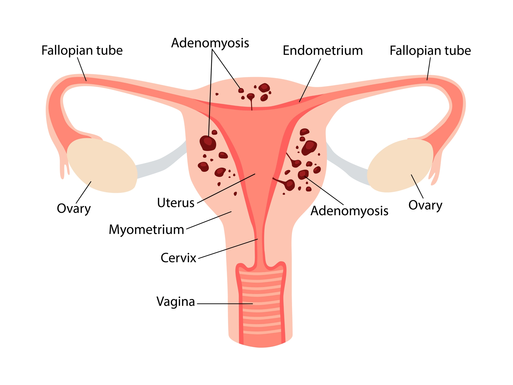 Adenomyosis: Causes, Symptoms, Diagnosis & Treatment