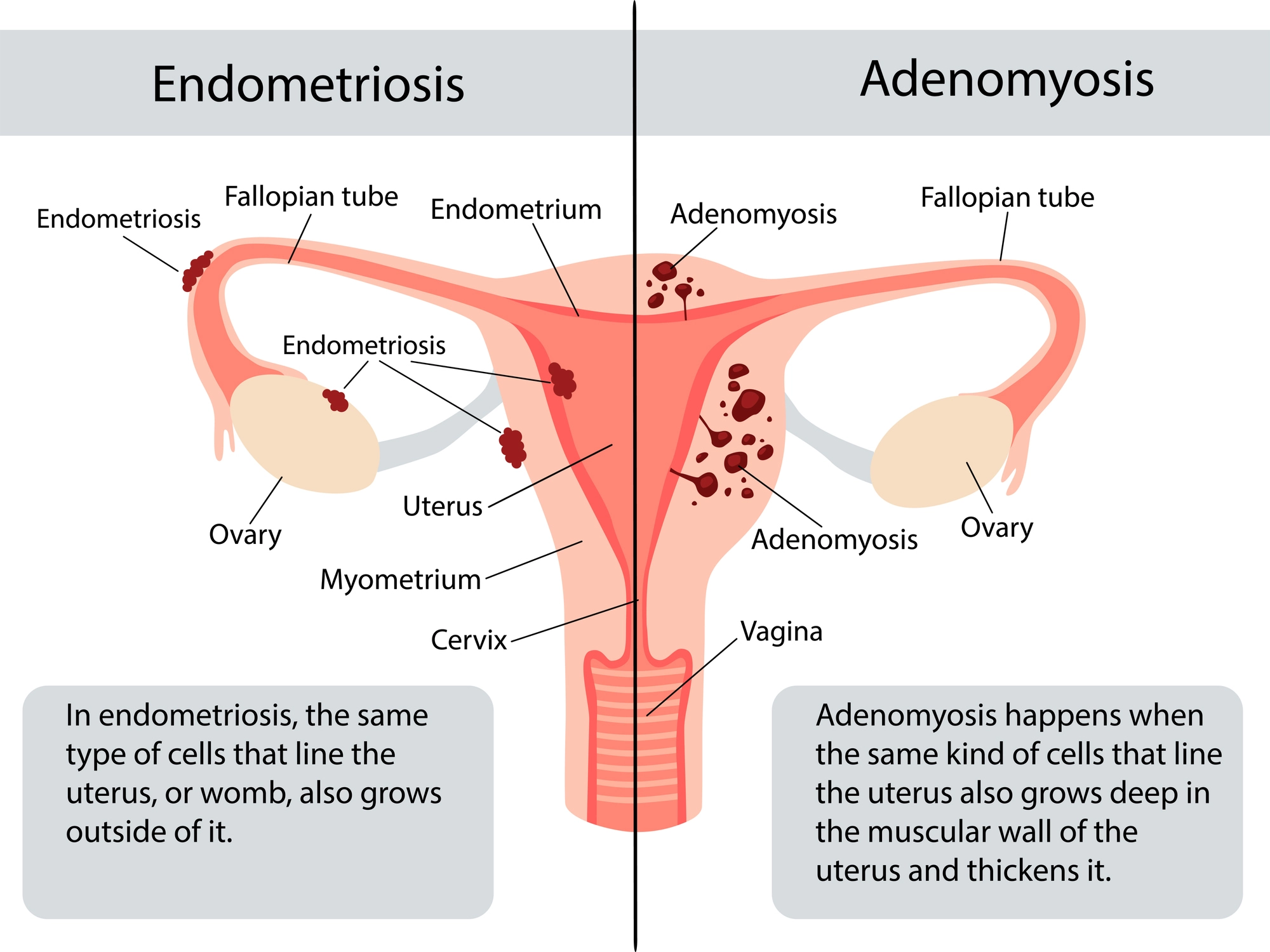 Adenomyosis: Causes, Symptoms, Diagnosis & Treatment