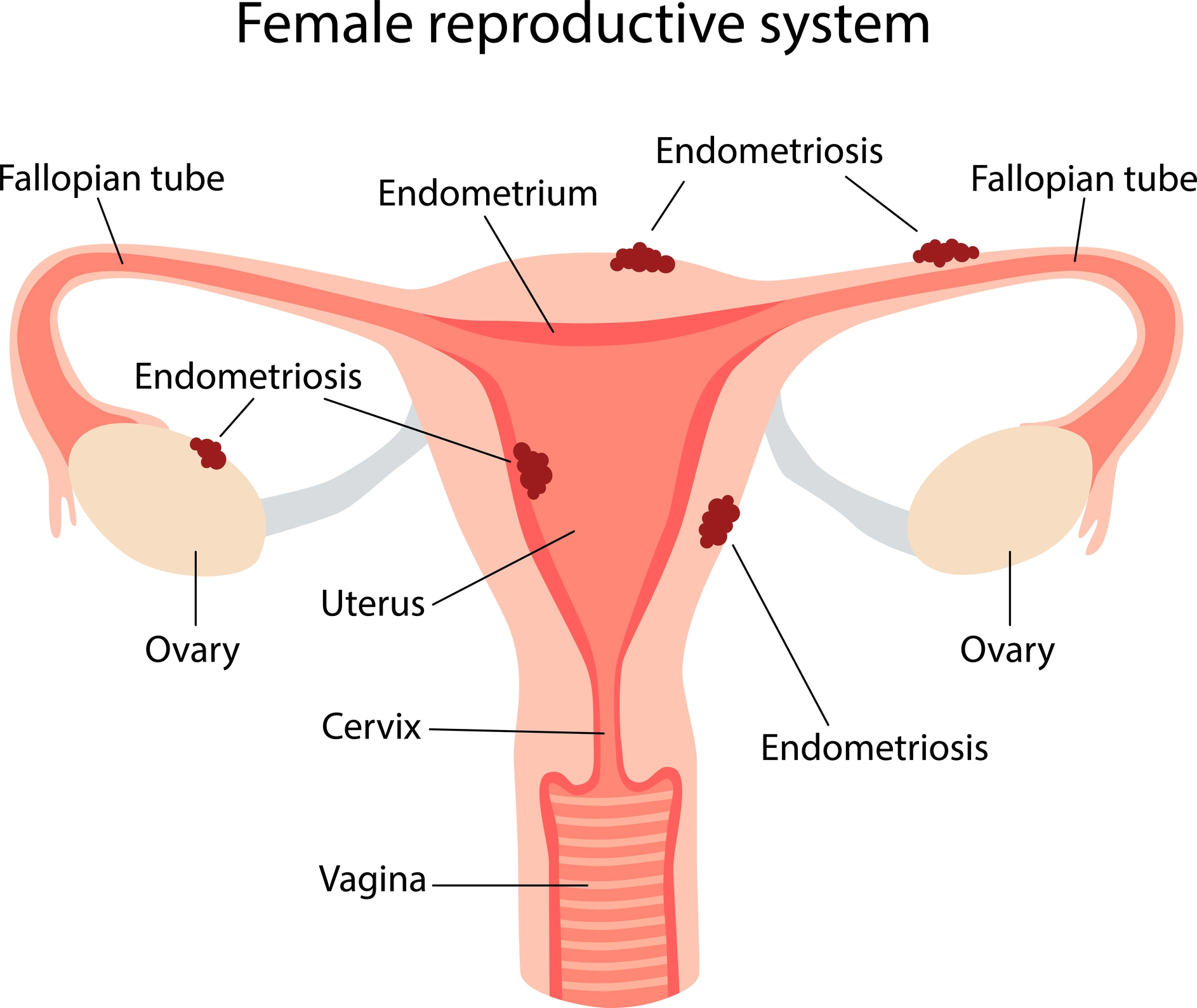 Endometriosis happens when tissue similar to the lining of the uterus  (womb) grows outside of the uterus. Symptoms of endometriosis…