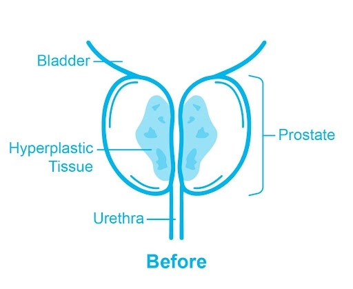 Benign Prostatic Hyperplasia (BPH) | Pantai Hospitals